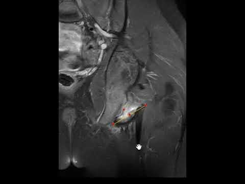 Video: Ischium - Structure, Function, Causes Of Pain, Fracture