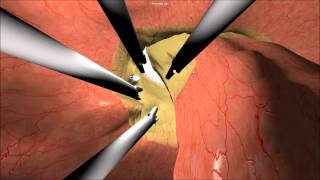 Virtual Surgery Project Summary