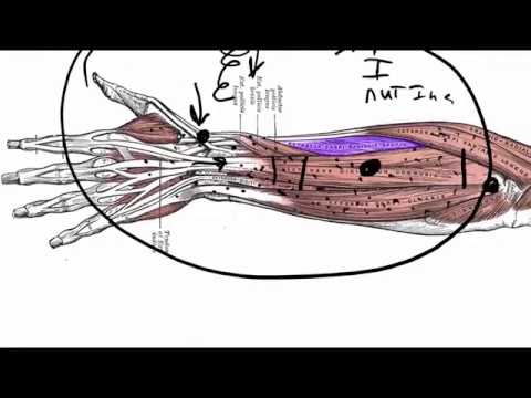 what really causes guitar tendonitis and why haven t you fixed it