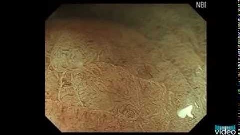 Endoscopic Image of Gastric Adenoma: Magnifying Endoscopy with Narrow-Band Imaging