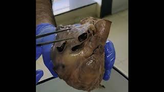 Dissection External features of heart part 1 screenshot 2