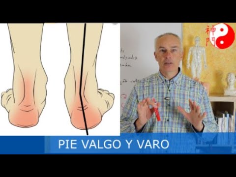 Tratamiento para PIE VALGO Y VARO con medicina china