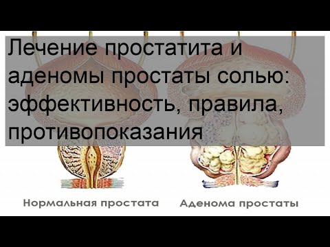 Лечение простатита и аденомы простаты солью: эффективность, правила, противопоказания