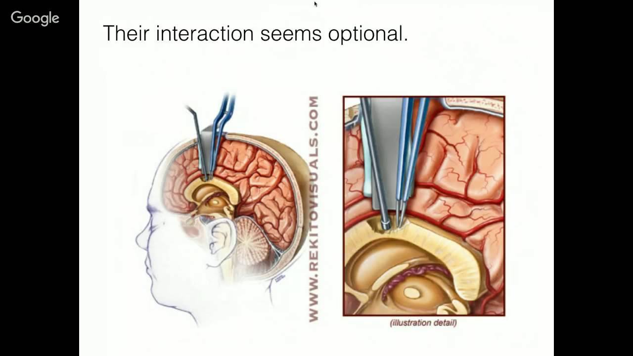 Split brain. Операция на головном мозге. Операция через нос головного мозга. Залезть в мозг через нос. Фото после удаления опухоли гипофиза через нос.