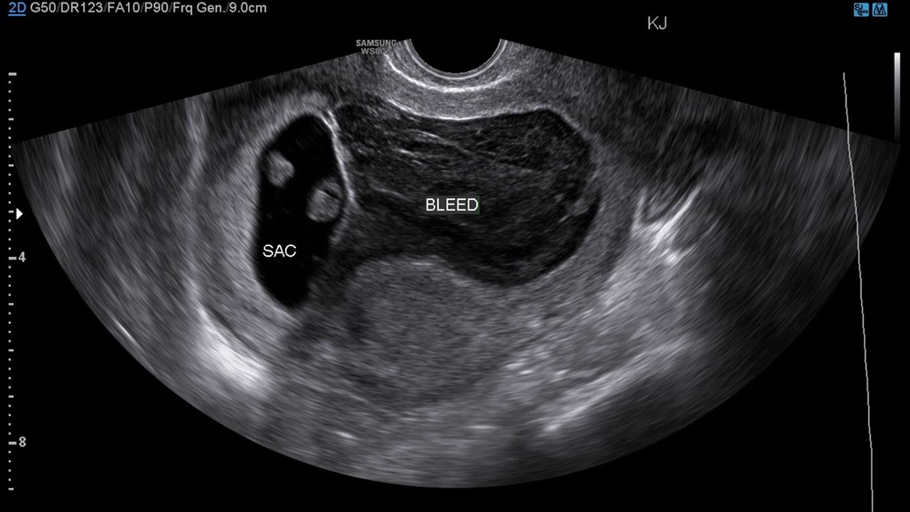 What Is Subchorionic Hematoma Causes Of Subchorionic Hematoma Youtube