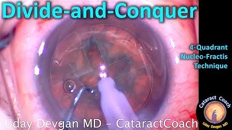 Divide and Conquer Phaco Technique for Cataract Surgery