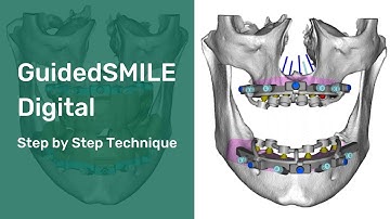 GuidedSMILE Digital: A Revolutionary, Fully Integrated Fiducial System