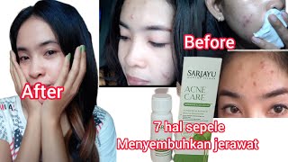 OBAT JERAWAT PALING AMPUH 'AJAIB' ⁉️ACNE CARE, SEMBUHKAN BREAKOUT TOTAL ‼️