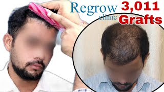 Best Hair Transplant Result 2021 || Diffuse Pattern || 3,011 Grafts ||  @Regrow Clinic ​