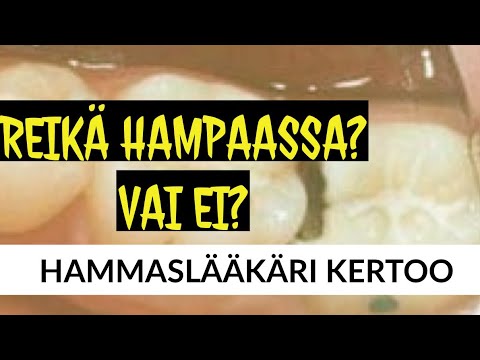 Video: Kiilan Muotoinen Hampaiden Vika - Hoito, Syyt, Miten Hoitaa Kotona