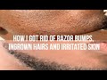 HOW I GOT RID OF RAZOR BUMPS AND INGROWN HAIRS