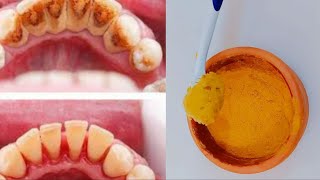 تبييض الأسنان في المنزل في دقيقه كيف تبيض اسنانك الصفراء من مكونات طبيعية وفعالة 100%