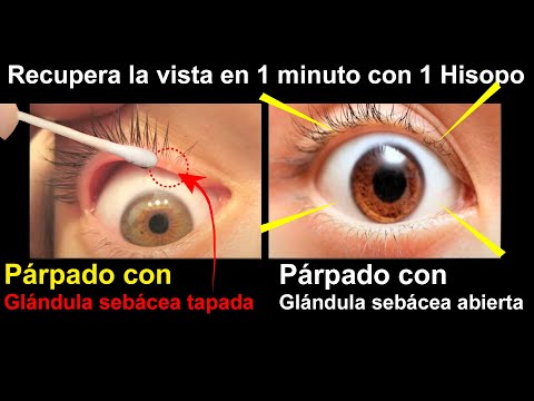 Como recuperar la vista con 1 solo <strong>Hisopo</strong>