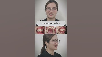 Khuôn mặt thay đổi thế nào sau khi niềng răng? | Dr Cường Official