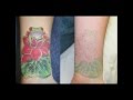 Excision Removal Of Tattoo