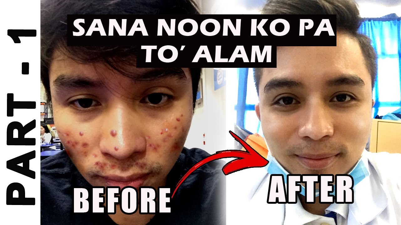 How to Treat Acne and Pimples on Face | How to Get Rid of Acne | Prevent Acne and Pimple - PART