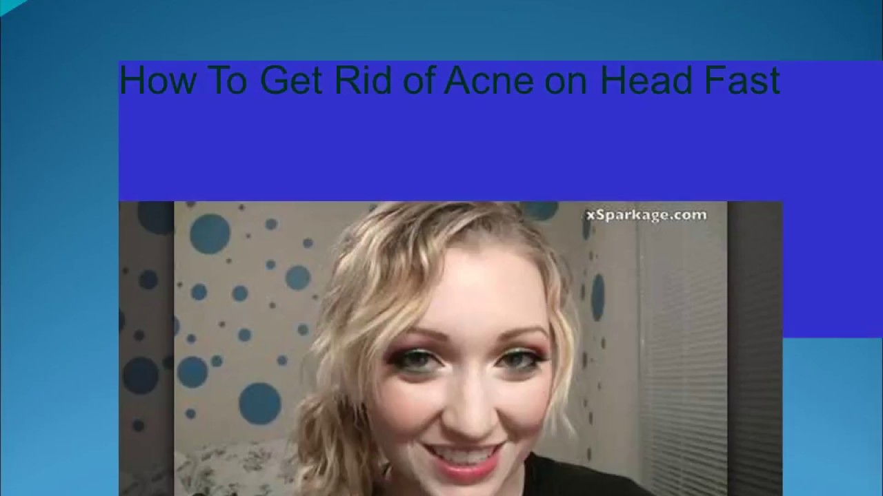 How To Get Rid Of Pimples On Forehead Can Wellbutrin Cause Acne