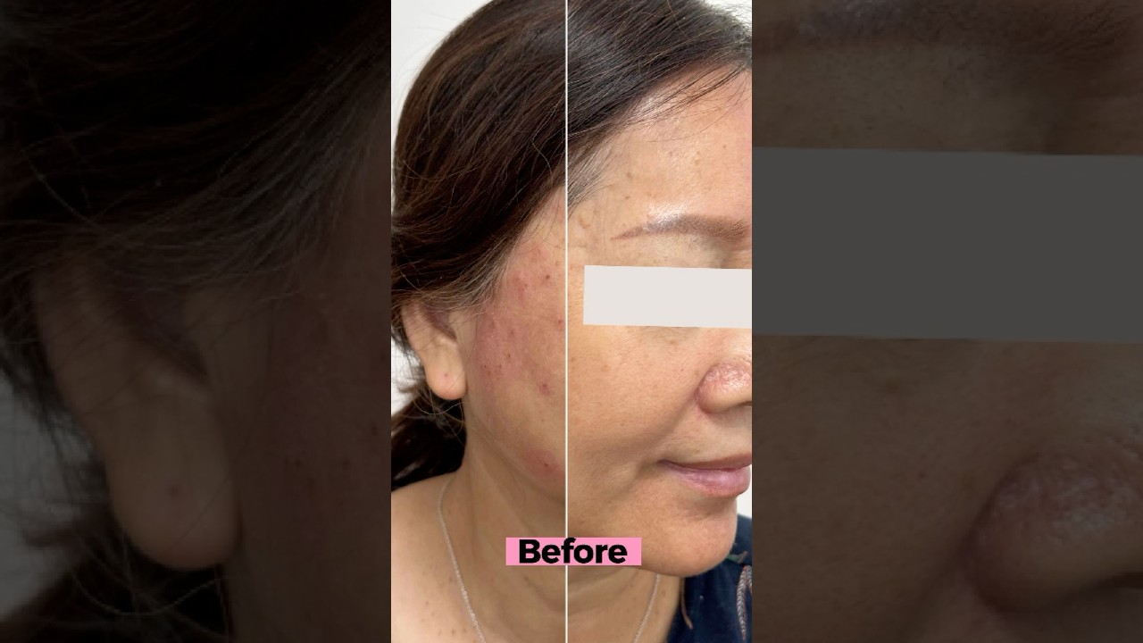 Pico Laser at Bared Monkey fix sun damage, evens skin tone, and brings back your glow.