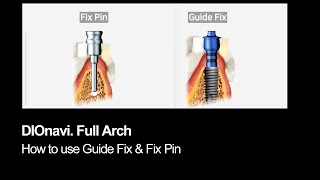 How to fixate the surgical guide? Guide Fix and Guide Fix Pin