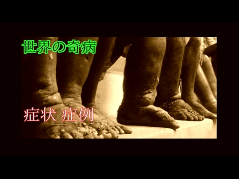 奇病 衝撃 世界の奇病まとめ Youtube 奇病 衝撃 世界の奇病まとめ Youtube
