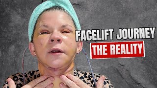 Facelift Recovery Day 6 Brain Fog And Rambling