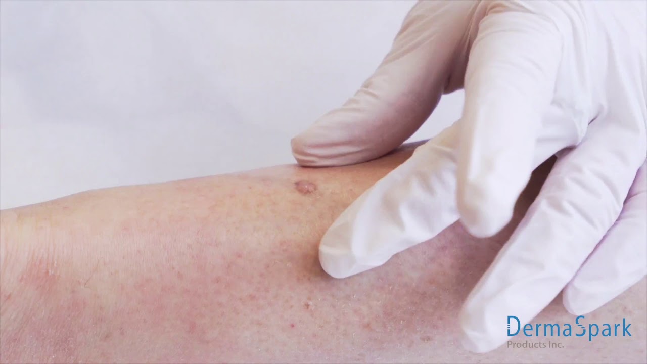 FreezPen Cryotherapy   Training Video