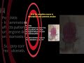 Pouchitis (Part I): Diagnosis and Management for Sx Residents. #shortsvideo  #IBD #pouchitis