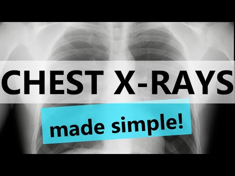 The ULTIMATE GUIDE to chest x-ray interpretation