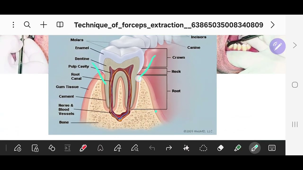 المرحلة الثالثة طب الاسنان/ المحاضرة الخامسة Techneque of forceps extraction