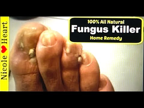 Home Remedy for Toenail Fungus & Athlete's Foot | Natural Fungus Killer by Nicoles Heart