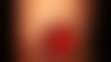 Belt loop technique for scleral fixation of a capsular tension segment for a dislocated cataract