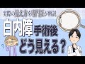 【白内障手術後の見え方】単焦点レンズで“遠く”と“近く”どちらを選ぶ？メガネは必要？術後の見え方を眼科医が徹底解説！
