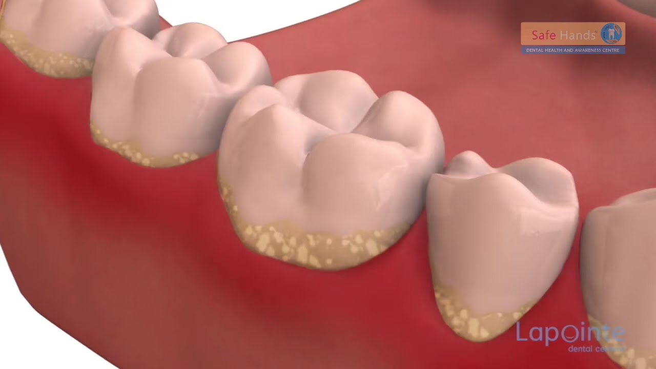 Dental Plaque: A Bacterial Habitat