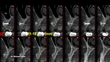 Two staged augmentation with tenting screws and straumann implants