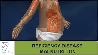 DEFICIENCY DISEASE : MALNUTRITION