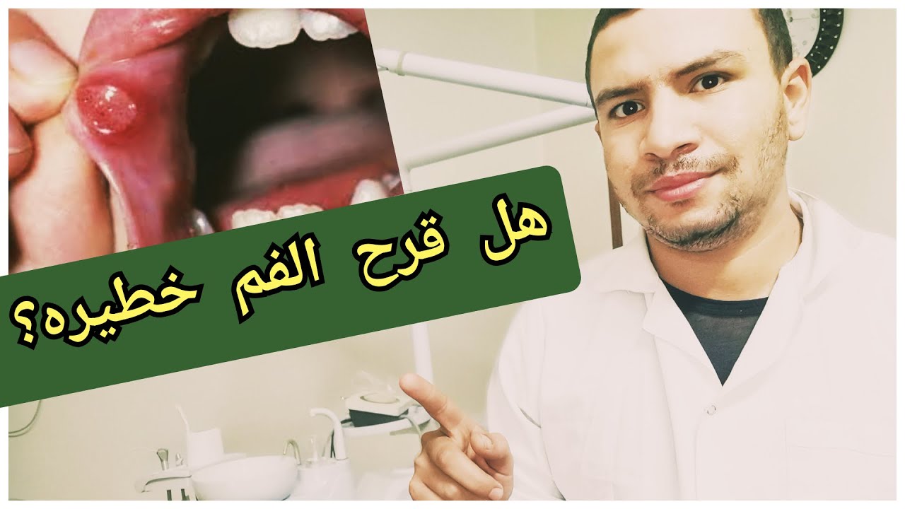 متى تكون قرح الفم خطيره و يجب علاجها فورا