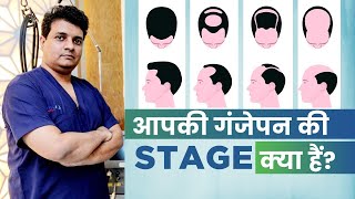 How to Recognise Your Grade of Baldness? | How many grafts do i need for Hair Transplant?