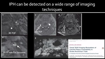 Scientific Session II 3 The Value of MR Vessel Wall Imaging in Cryptogenic Stroke – Ajay Gupta