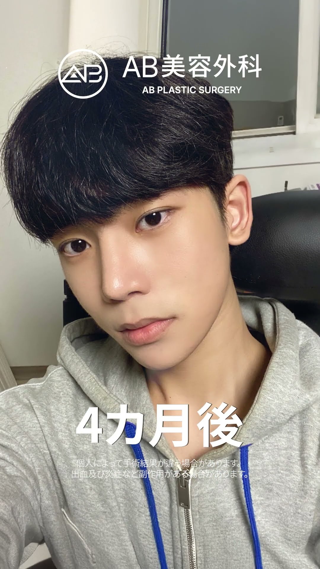 劇的変化！鼻と輪郭整形で生まれ変わった彼 #韓国整形 #美容