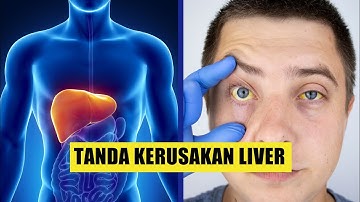 Kerap Disepelekan, Ini 7 Tanda Liver Rusak