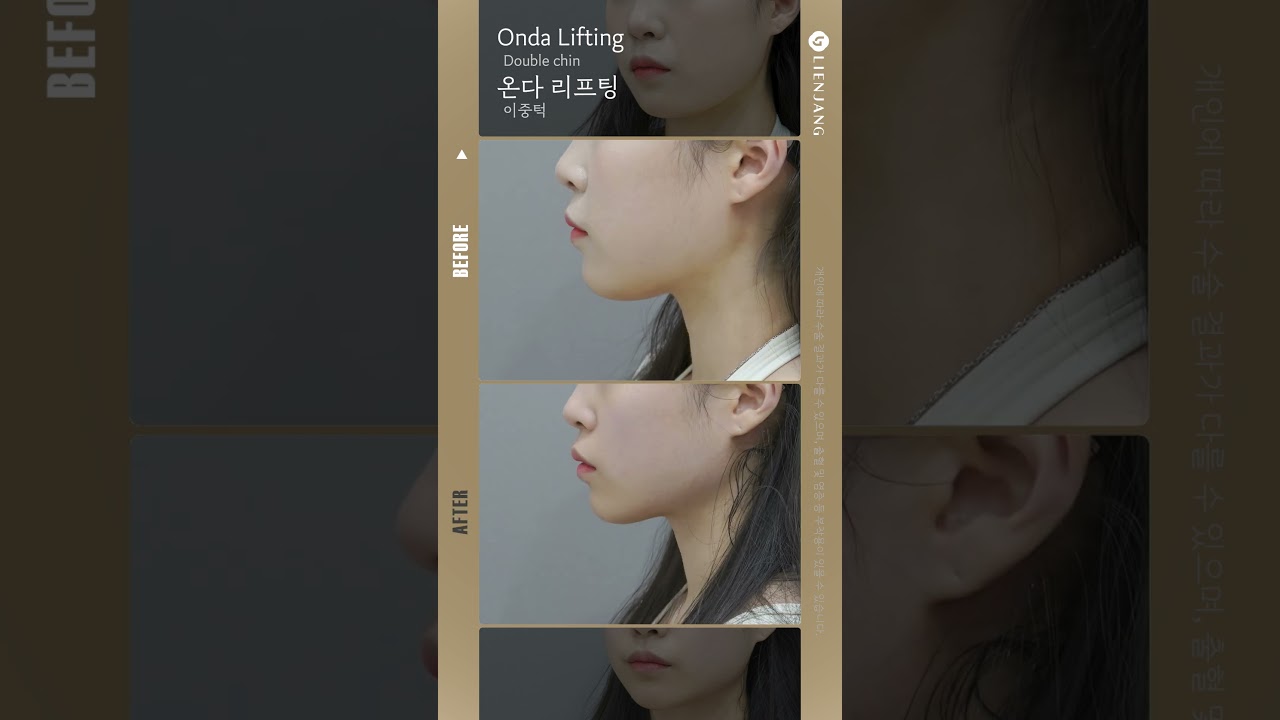 [Риенжанг гоо сайхны мэс заслын эмнэлэг] Онда лифтинг давхар эрүү