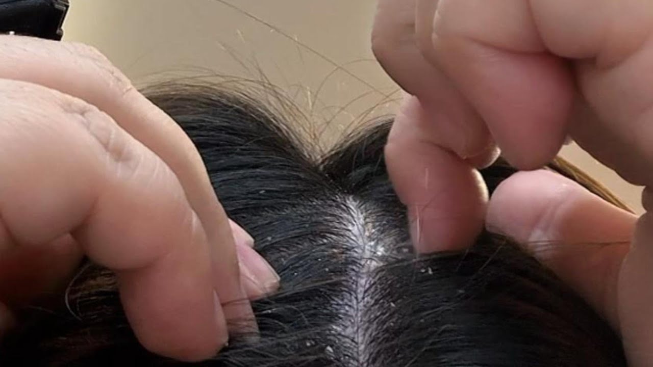 No Brush Needed: Short Nails Scratching & Removing Stubborn Flakes