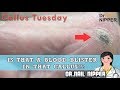 Is that a Blood Blister in that Callus? #27 - Callus Tuesday