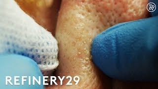 Why Extractions Are Satisfying To Watch But Dangerous | Macro Beauty | Refinery29