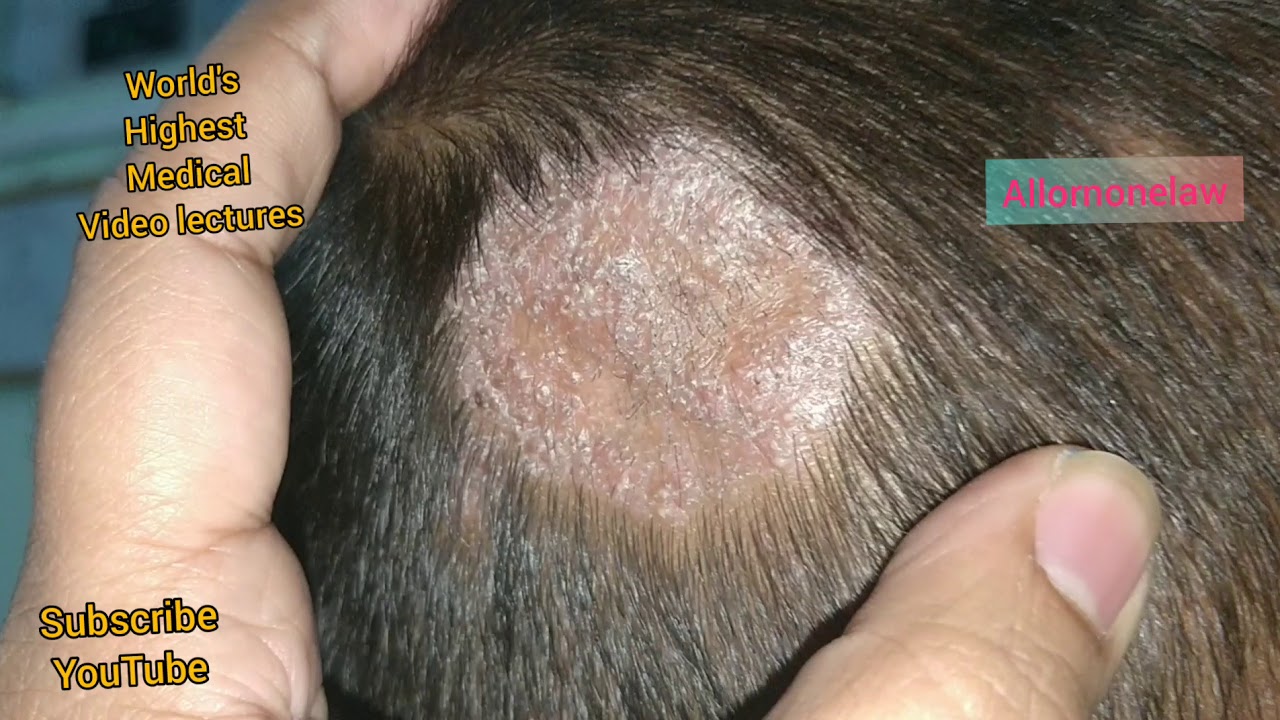 Top 80 Fungal Infection In Hair Best Ineteachers