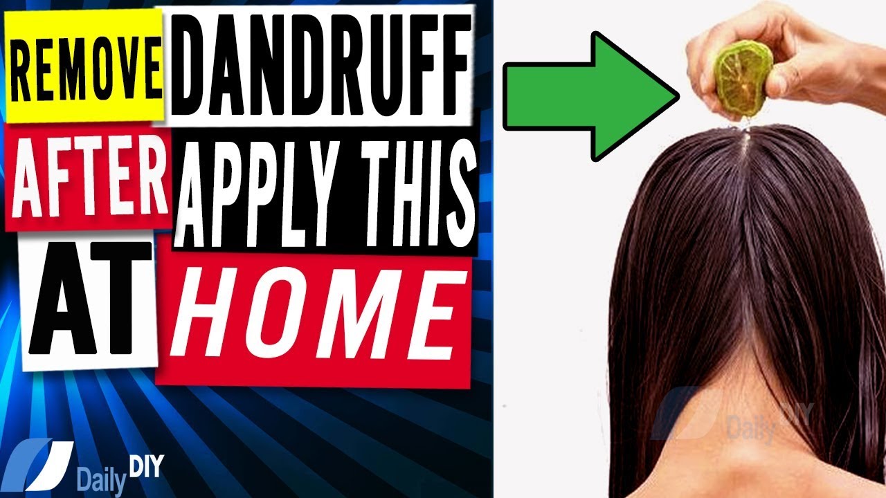 How to Get Rid of Dandruff Naturally - Best Dandruff Treatments - YouTube