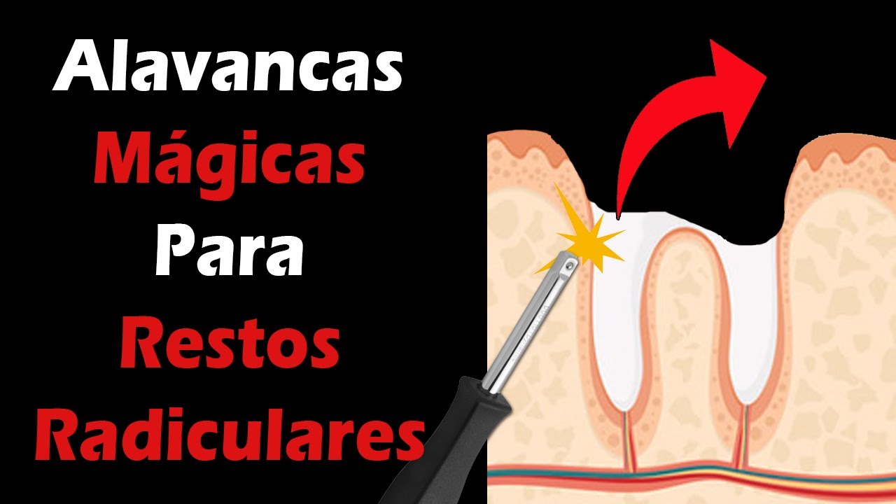 Extração De Raiz De Dente - RETOEDU