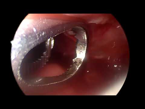 Decorticação pulmonar - Quilotórax