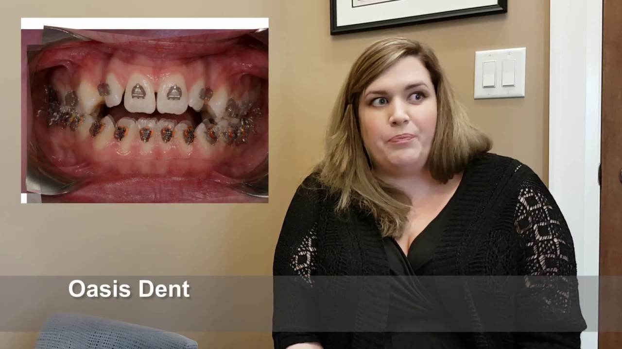 Adult Open Bite Corretion with NO JAW SURGERY & NON EXTRACTION | ALF Treatment