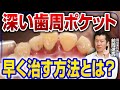 〇〇mm以上は即抜歯！？歯周ポケットの基準と改善方法を解説